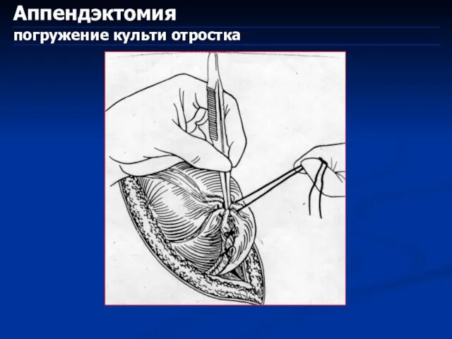 Аппендэктомия погружение культи отростка