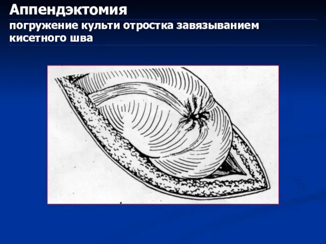 Аппендэктомия погружение культи отростка завязыванием кисетного шва