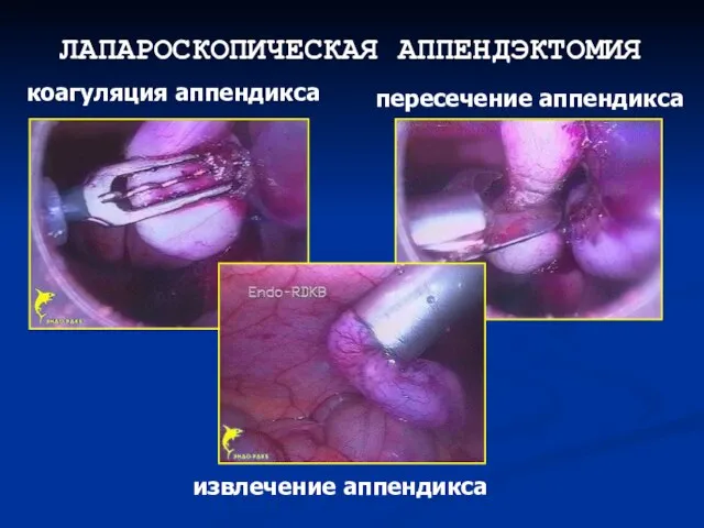 ЛАПАРОСКОПИЧЕСКАЯ АППЕНДЭКТОМИЯ коагуляция аппендикса пересечение аппендикса извлечение аппендикса