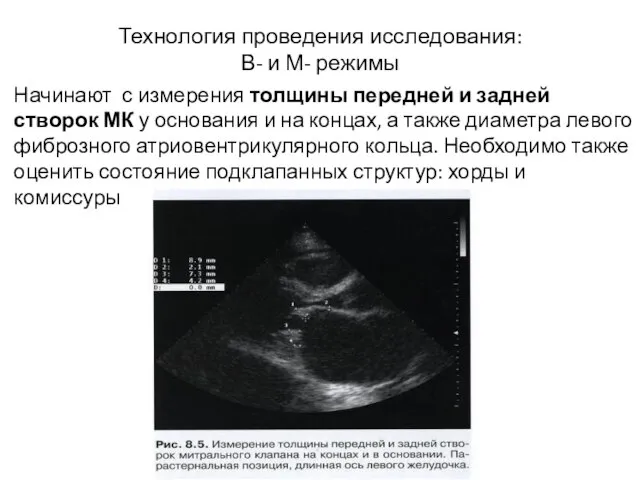 Технология проведения исследования: В- и М- режимы Начинают с измерения толщины передней