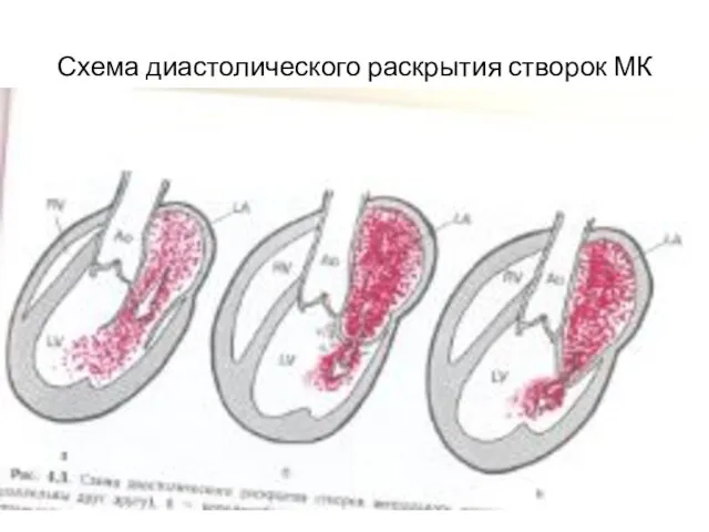 Схема диастолического раскрытия створок МК