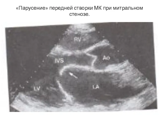 «Парусение» передней створки МК при митральном стенозе.