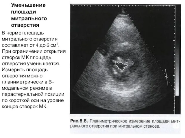 Уменьшение площади митрального отверстия В норме площадь митрального отверстия составляет от 4