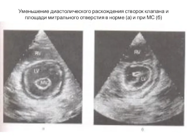 Уменьшение диастолического расхождения створок клапана и площади митрального отверстия в норме (а) и при МС (б)