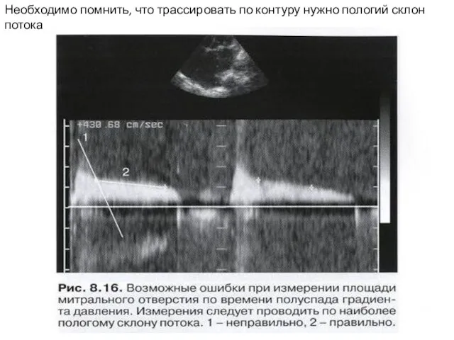 Необходимо помнить, что трассировать по контуру нужно пологий склон потока