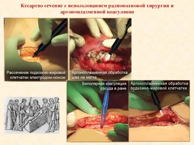 Кесарево сечение с использованием радиоволновой хирургии и аргоноплазменной коагуляции