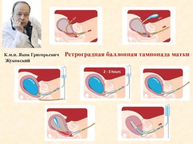 К.м.н. Яков Григорьевич Жуковский Ретроградная баллонная тампонада матки