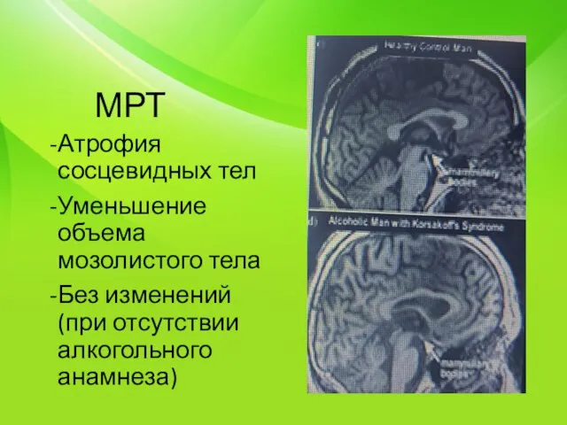 МРТ Атрофия сосцевидных тел Уменьшение объема мозолистого тела Без изменений (при отсутствии алкогольного анамнеза)