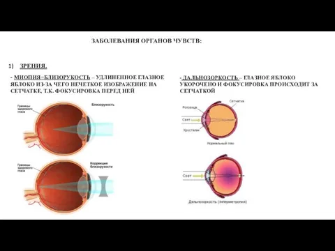 ЗРЕНИЯ. - МИОПИЯ=БЛИЗОРУКОСТЬ – УДЛИНЕННОЕ ГЛАЗНОЕ ЯБЛОКО ИЗ-ЗА ЧЕГО НЕЧЕТКОЕ ИЗОБРАЖЕНИЕ НА