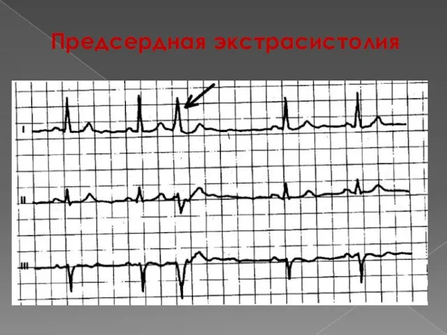 Предсердная экстрасистолия