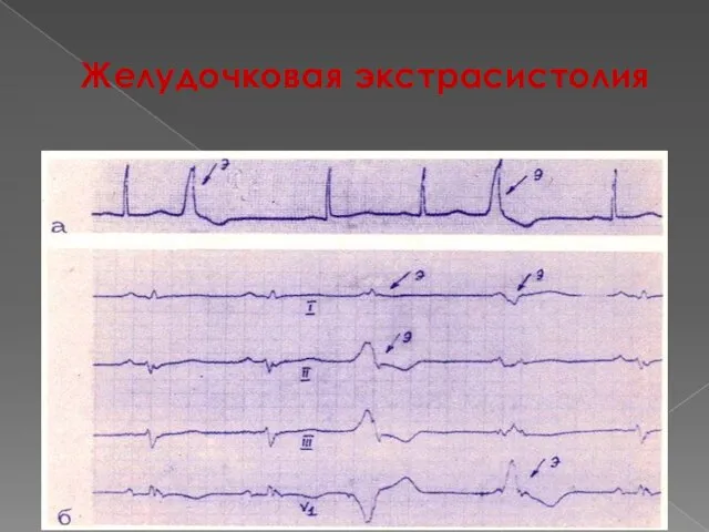 Желудочковая экстрасистолия