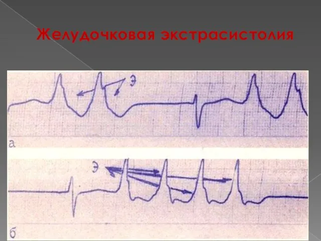 Желудочковая экстрасистолия