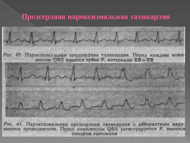 Предсердная пароксизмальная тахикардия