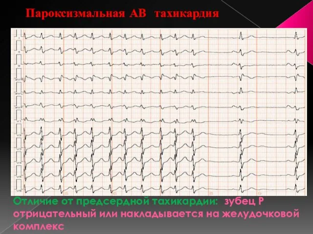 Отличие от предсердной тахикардии: зубец Р отрицательный или накладывается на желудочковой комплекс Пароксизмальная АВ тахикардия