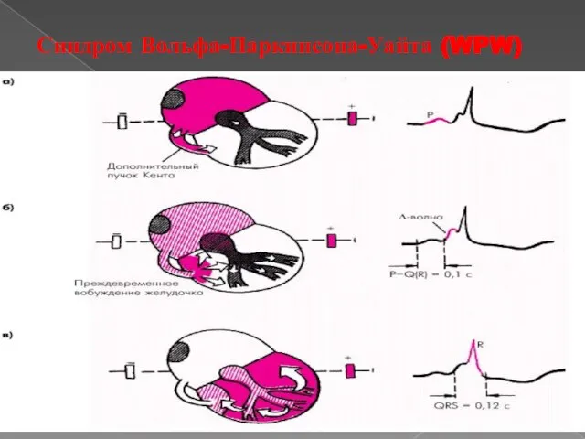 Синдром Вольфа-Паркинсона-Уайта (WPW)