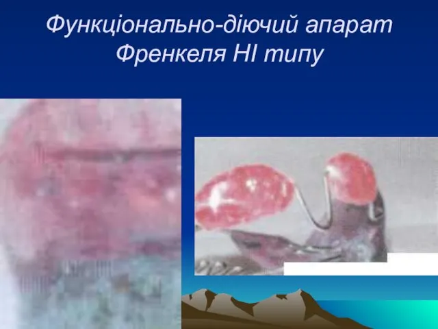 Функціонально-діючий апарат Френкеля НІ типу