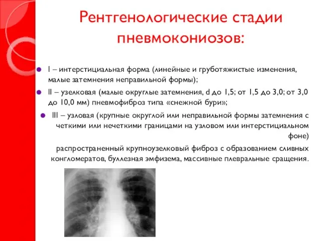 Рентгенологические стадии пневмокониозов: I – интерстициальная форма (линейные и груботяжистые изменения, малые