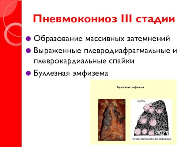 Пневмокониоз III стадии Образование массивных затемнений Выраженные плевродиафрагмальные и плеврокардиальные спайки Буллезная эмфизема