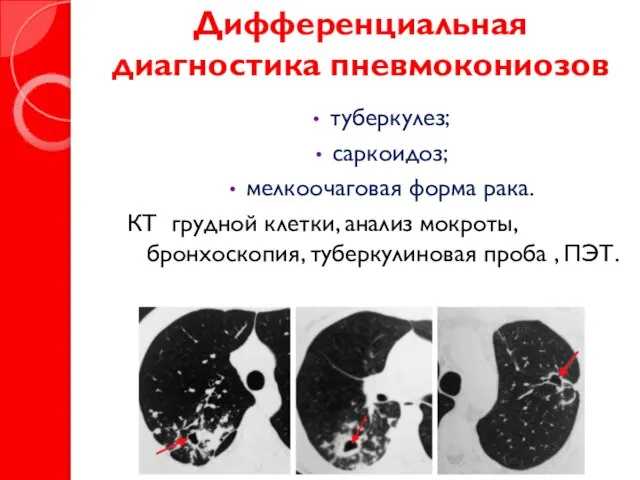 Дифференциальная диагностика пневмокониозов туберкулез; саркоидоз; мелкоочаговая форма рака. КТ грудной клетки, анализ