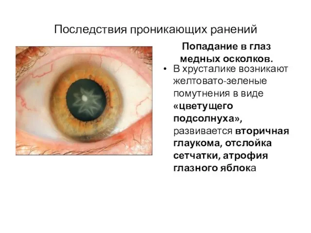 Последствия проникающих ранений Халькоз Попадание в глаз медных осколков. В хрусталике возникают