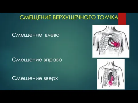 СМЕЩЕНИЕ ВЕРХУШЕЧНОГО ТОЛЧКА Смещение влево Смещение вправо Смещение вверх