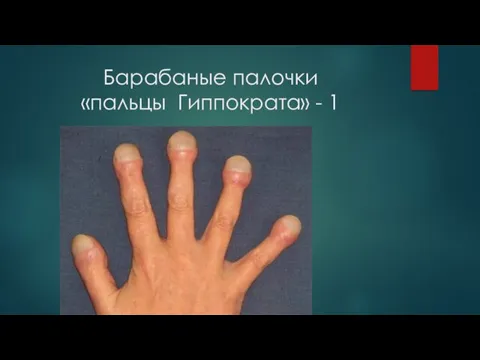 Барабаные палочки «пальцы Гиппократа» - 1
