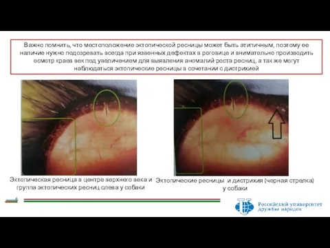 Важно помнить, что местоположение эктопической ресницы может быть атипичным, поэтому ее наличие