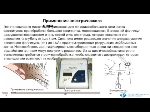 Применение электрического ножа Электроэпиляция может быть применена для лечения небольшого количества фолликулов,