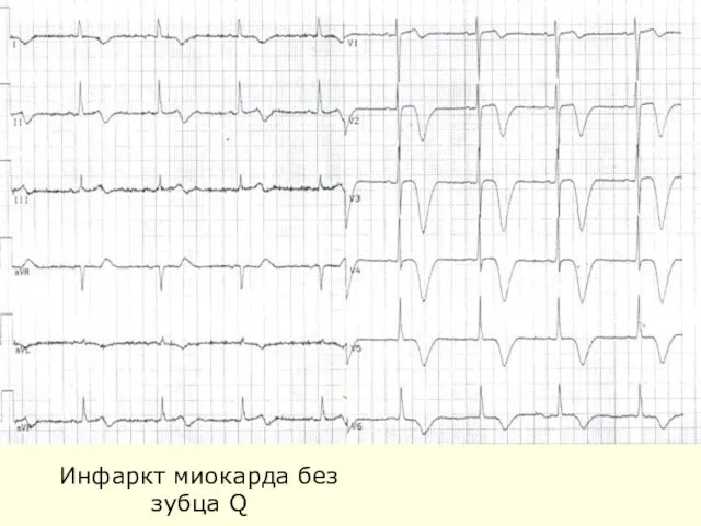 Инфаркт миокарда без зубца Q