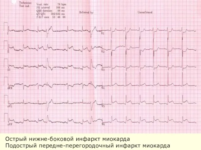 Острый нижне-боковой инфаркт миокарда Подострый передне-перегородочный инфаркт миокарда