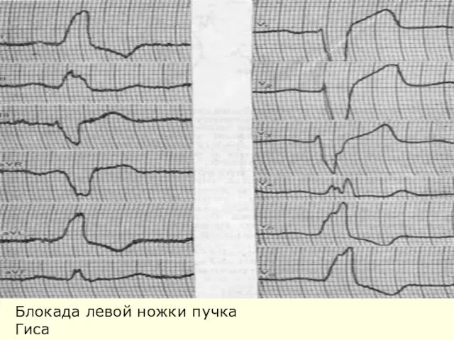 Блокада левой ножки пучка Гиса