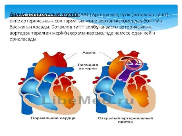 Ашық артериялық түтік(ААТ) Артериялық түтік (Боталлов түтігі) өкпе артериясының сол тармағын және