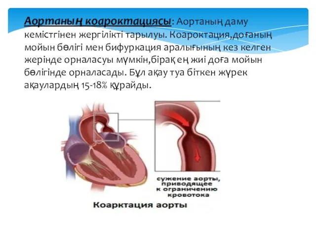 Аортаның коароктациясы: Аортаның даму кемістгінен жергілікті тарылуы. Коароктация,доғаның мойын бөлігі мен бифуркация