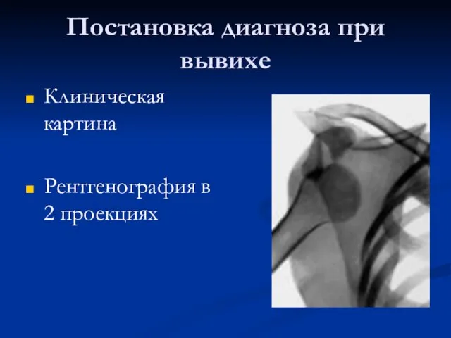 Постановка диагноза при вывихе Клиническая картина Рентгенография в 2 проекциях