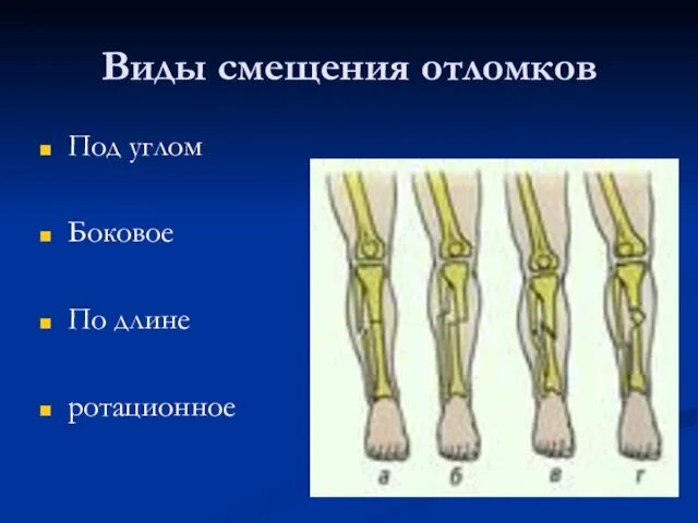 Виды смещения отломков Под углом Боковое По длине ротационное