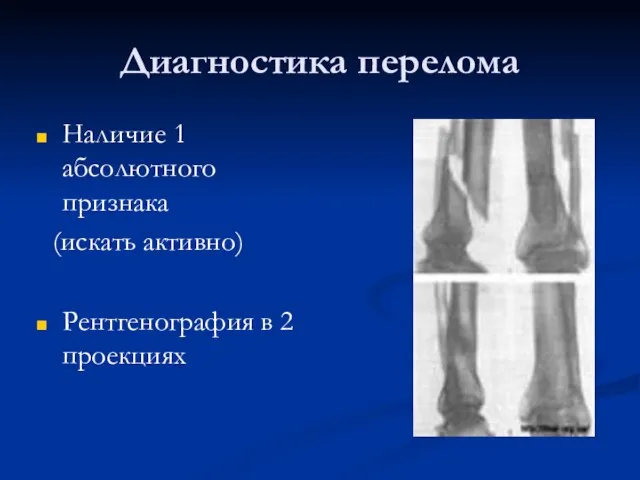 Диагностика перелома Наличие 1 абсолютного признака (искать активно) Рентгенография в 2 проекциях