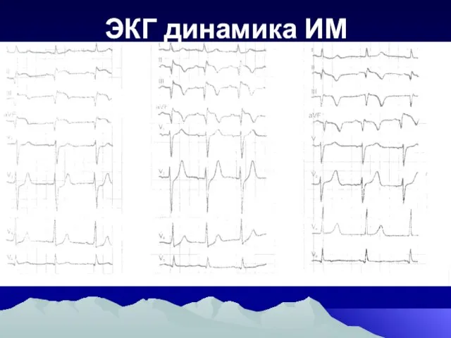 ЭКГ динамика ИМ