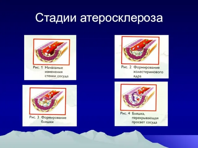 Стадии атеросклероза