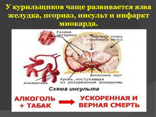 У курильщиков чаще развивается язва желудка, псориаз, инсульт и инфаркт миокарда.