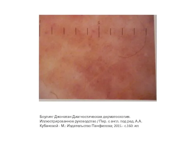 Боулинг Джонатан Диагностическая дерматоскопия. Иллюстрированное руководство / Пер. с англ. под ред.