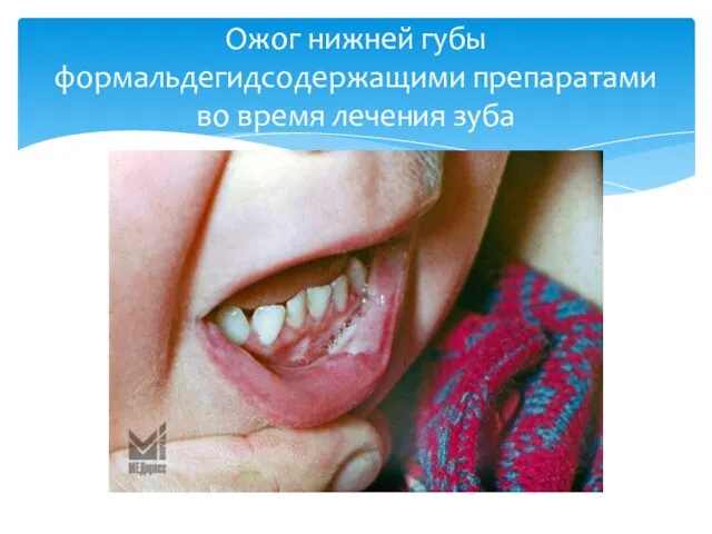 Ожог нижней губы формальдегидсодержащими препаратами во время лечения зуба