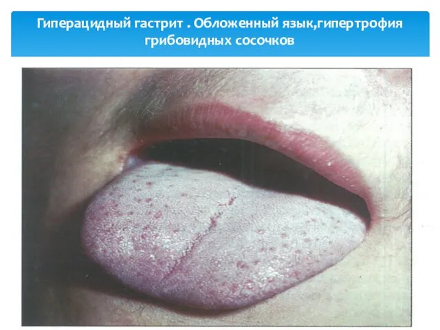 Гиперацидный гастрит . Обложенный язык,гипертрофия грибовидных сосочков