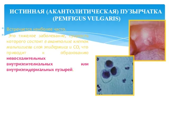 Встречается наиболее часто. Это тяжелое заболевание, сущность которого состоит в акантолизе клеток