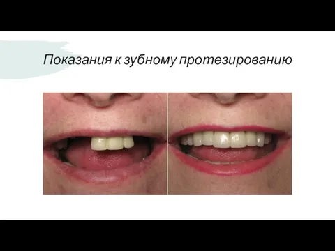 Показания к зубному протезированию