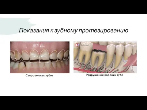 Показания к зубному протезированию Стираемость зубов Разрушение коронки зуба