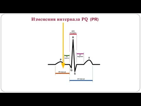 Изменения интервала PQ (PR)