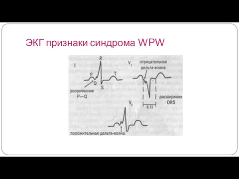 ЭКГ признаки синдрома WPW