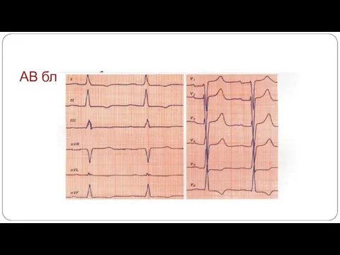 АВ блокада 1 степени