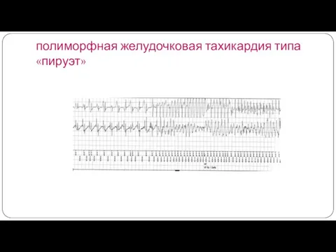 полиморфная желудочковая тахикардия типа «пируэт»