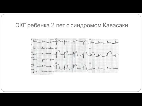 ЭКГ ребенка 2 лет с синдромом Кавасаки